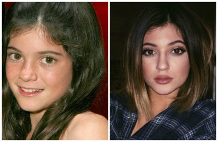 Kylie Jenner's Stunning Plastic Surgery Transformation