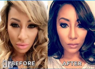 Hazel E Nose Job Before and After Instagram