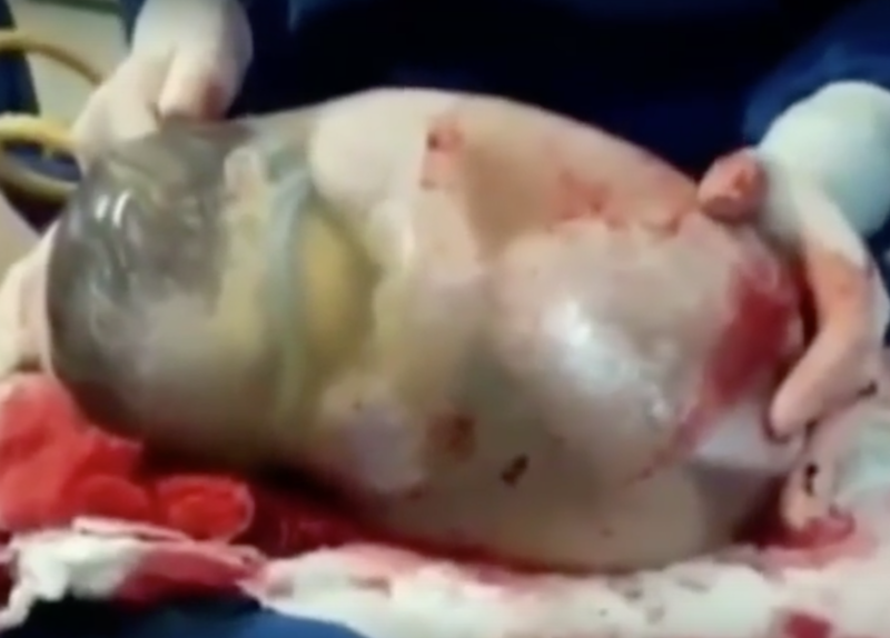 Baby born in amniotic sac