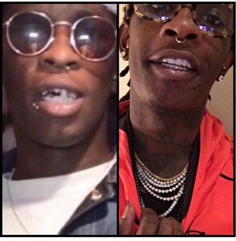 rappers teeth before and after