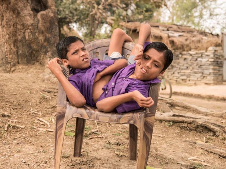 Remember Them? World Famous Conjoined Twins In India Turn 18 [Video