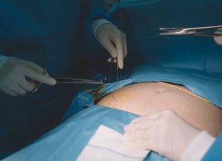 2 asian female surgeon and nurse conducting a surgery on an asian chinese senior woman on her abdomen in the operating room of hospital