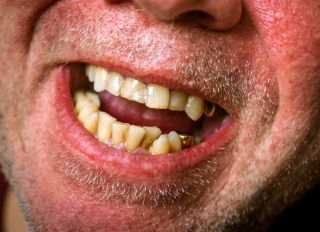 Close-Up Of Bad Teeth